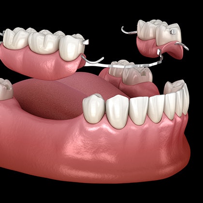 partial denture