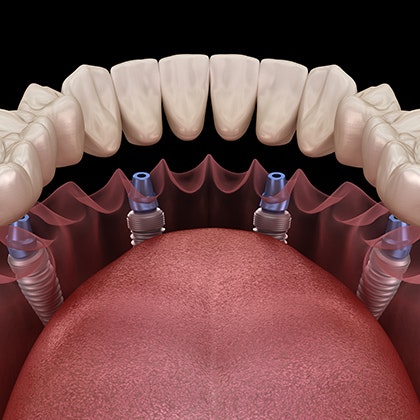 implant denture