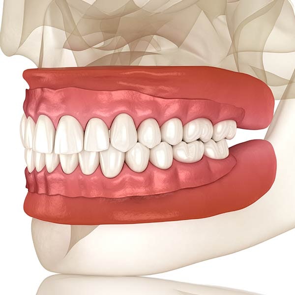 Dentures