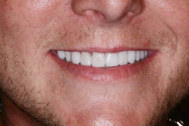 Dr. John Goodman's patient after a smile makeover
