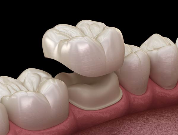 Illustration of a dental crown being placed on a tooth