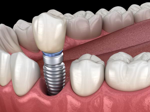 illustration of an implant-supported crown