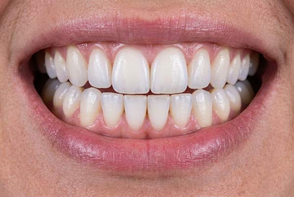 Dr. John Goodman's patient after orthodontics