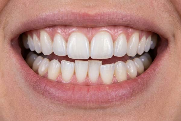 Dr. John Goodman's patient before orthodontics