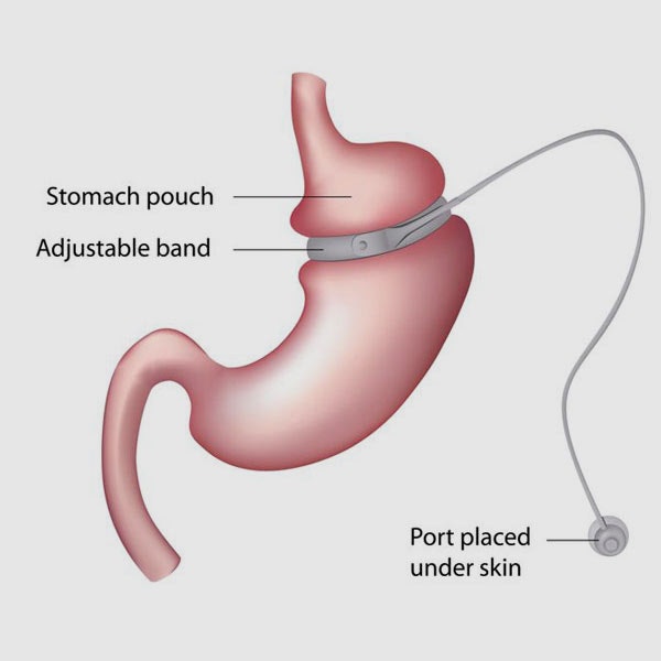 Informational graphic about LAP-BAND® surgery