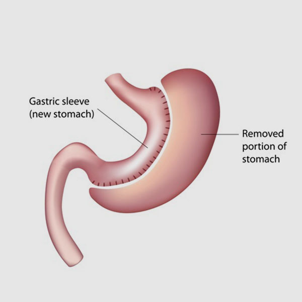 Informational graphic about gastric sleeve surgery