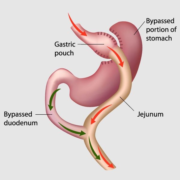 Informational graphic about gastric bypass surgery
