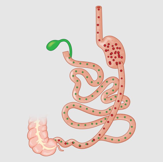 Duodenal switch diagram