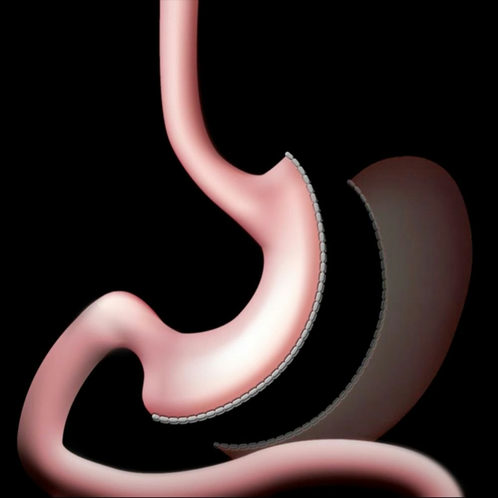 Vertical Sleeve Gastrectomy