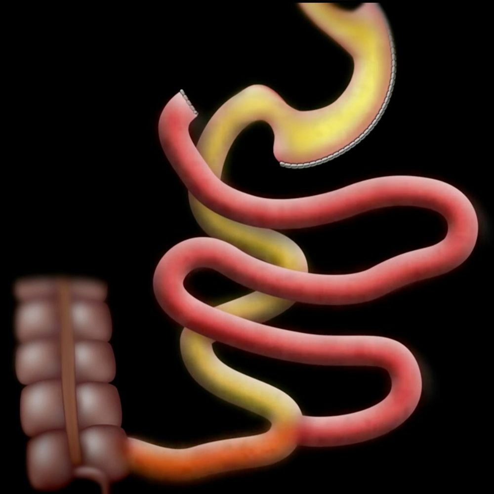 First half of small intestine is rerouted