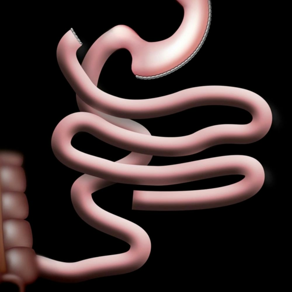 Half of small intestine is bypassed