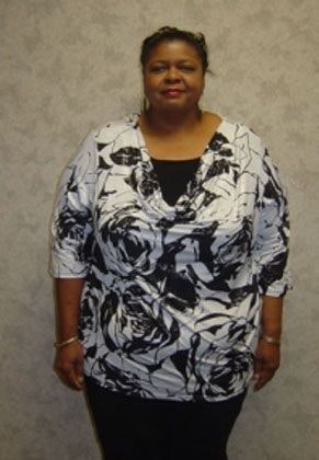 client before weight-loss surgery