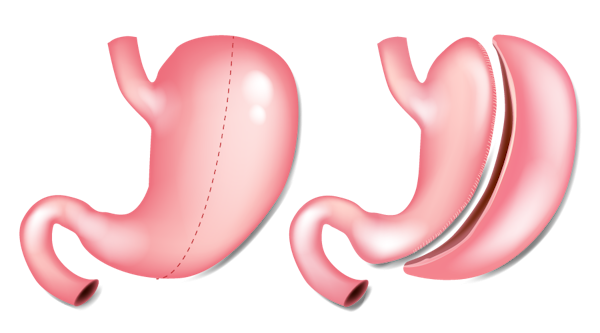 Illustration of gastric sleeve surgery (sleeve gastrectomy) before and after