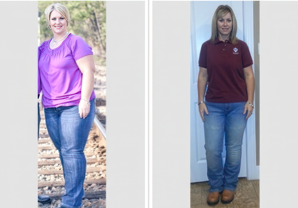 before and after weight loss surgery