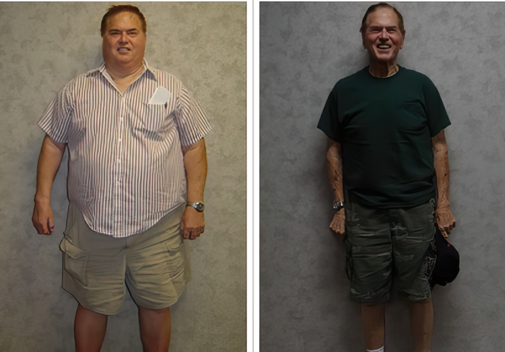 before and after weight loss surgery