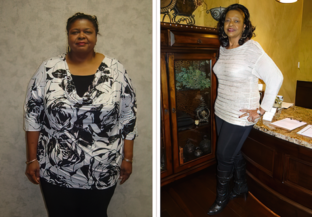 before and after weight loss surgery