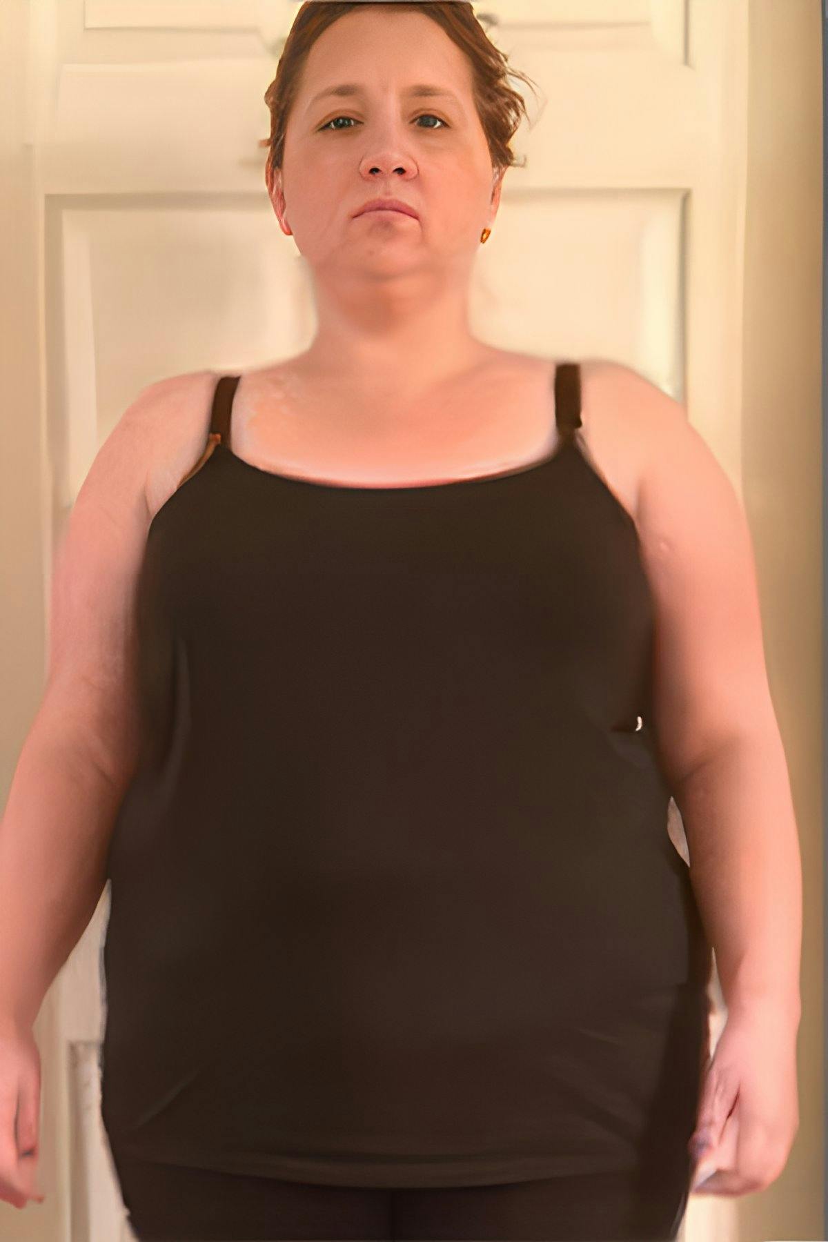 before gastric sleeve