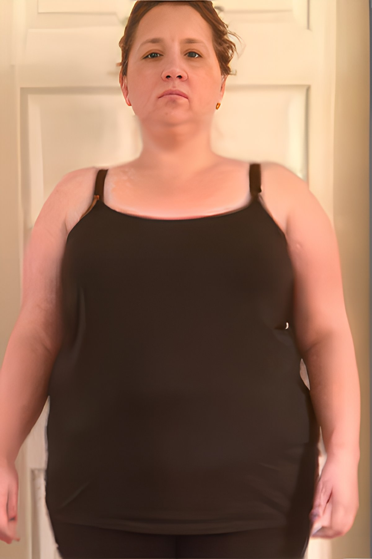 before gastric sleeve