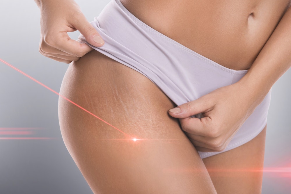 close up of stretch marks on a woman's leg being removed by a laser