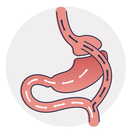 Gastric Bypass Illustration