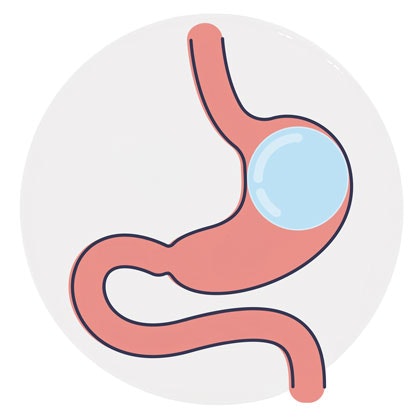 gastric balloon illustration