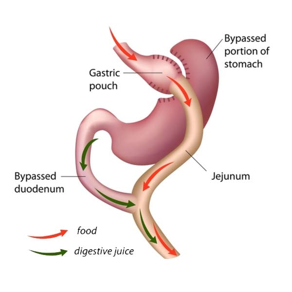 Gastric Bypass Revision
