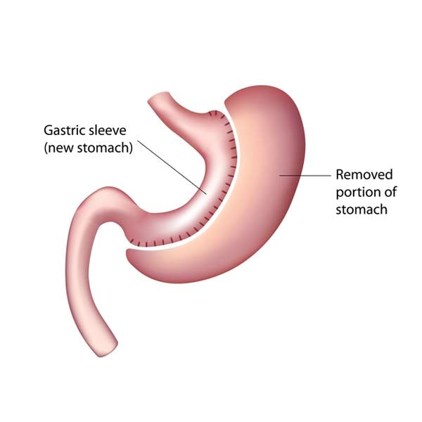 Gastric Sleeve Revisions