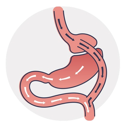Gastric bypass