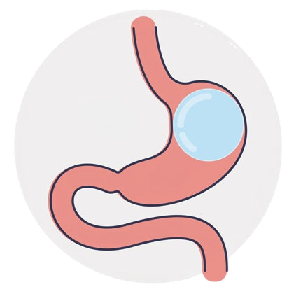 Gastric balloon