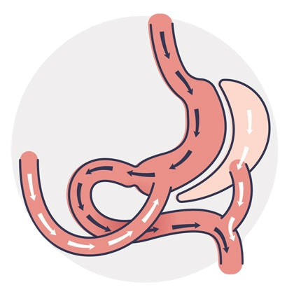 Duodenal Switch