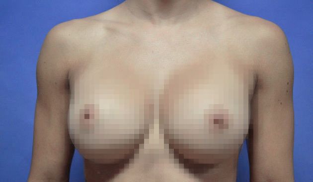 silicone implants
