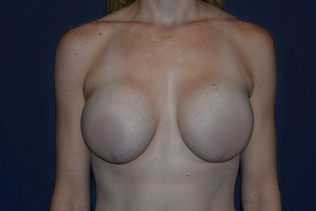 After Breast Lift
