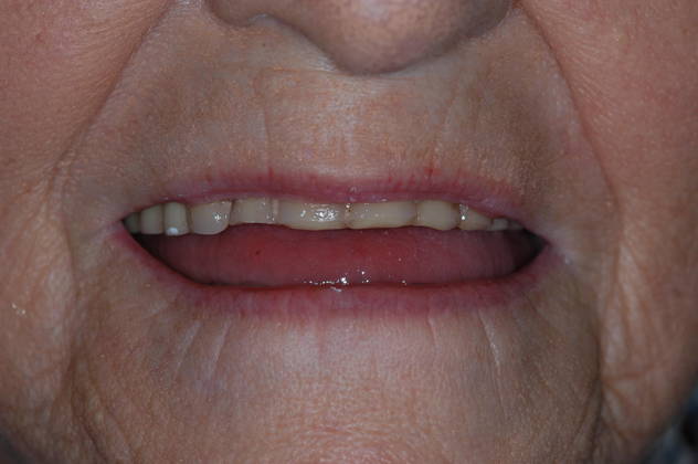 Before dentures from Fuqua Advanced Dental