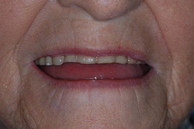 Before dentures from Fuqua Advanced Dental