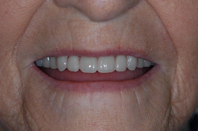 After dentures from Fuqua Advanced Dental