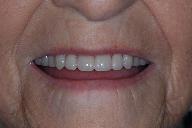 After dentures from Fuqua Advanced Dental