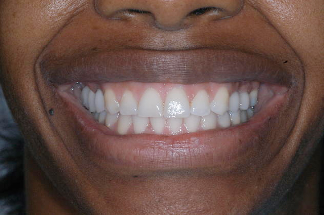Fuqua Advanced Dental's patient with new denture