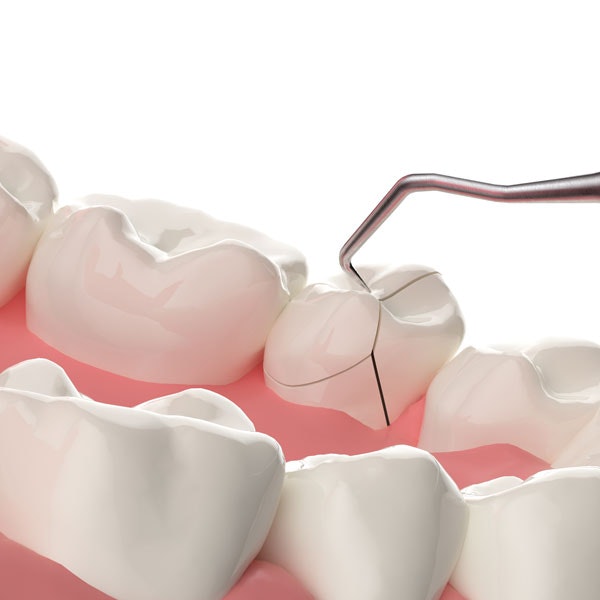 Cracked tooth