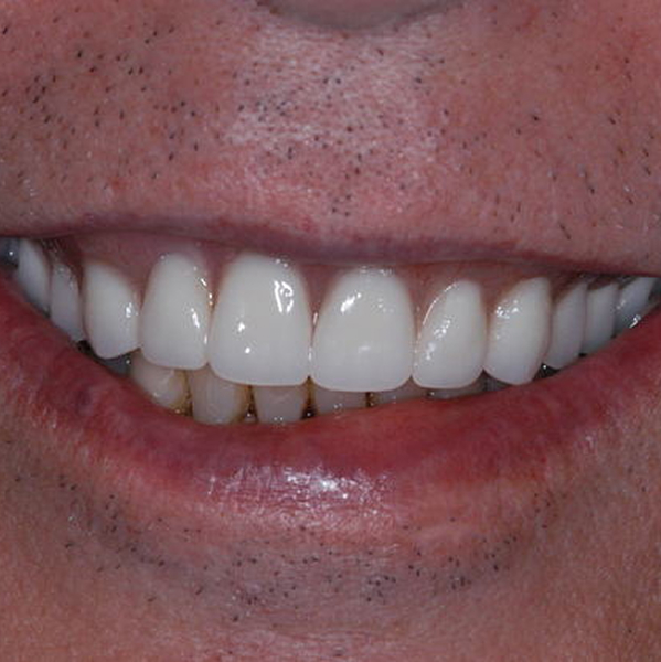 Real patient denture case