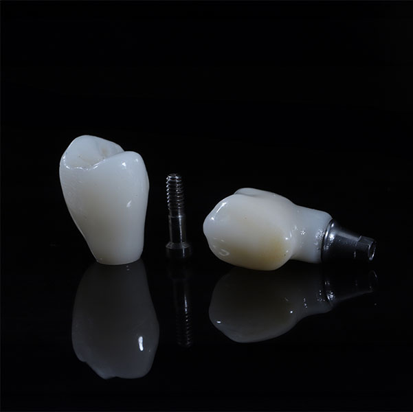 Dental implant