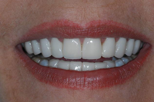 smile after veneers