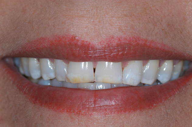 smile before veneers