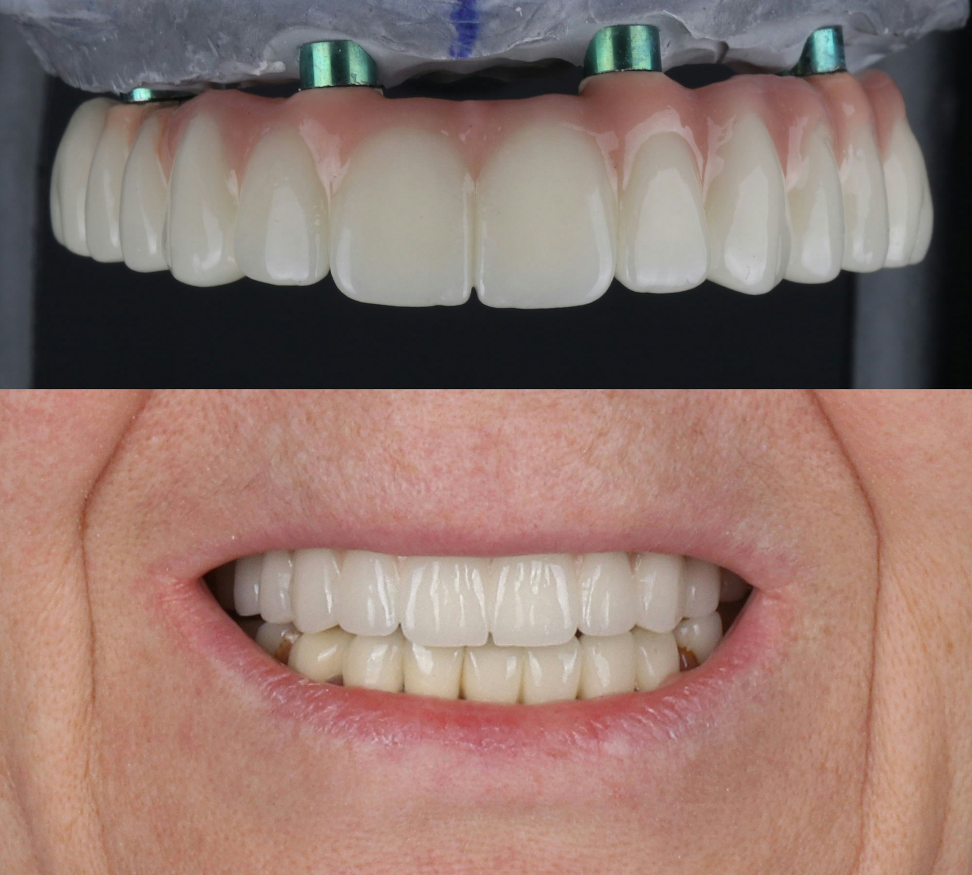 all-on-4 denture in patient's mouth