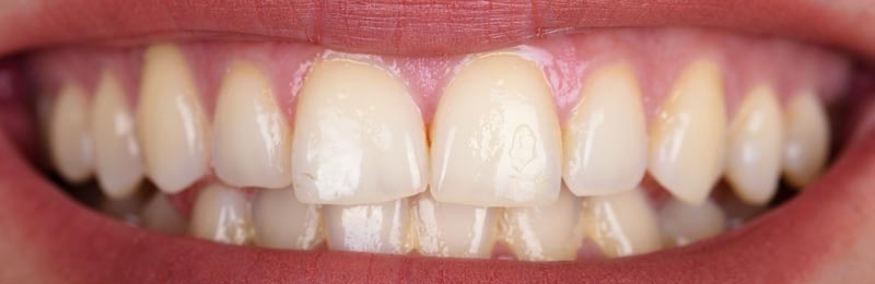 before whitening treatment