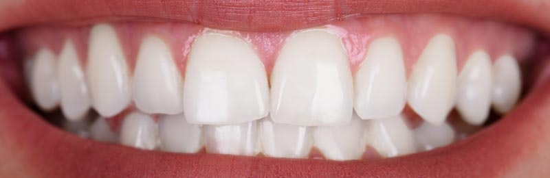 after whitening treatment