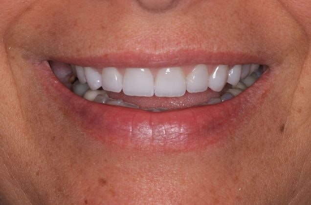 After veneers