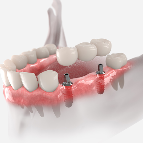 implant-supported bridge