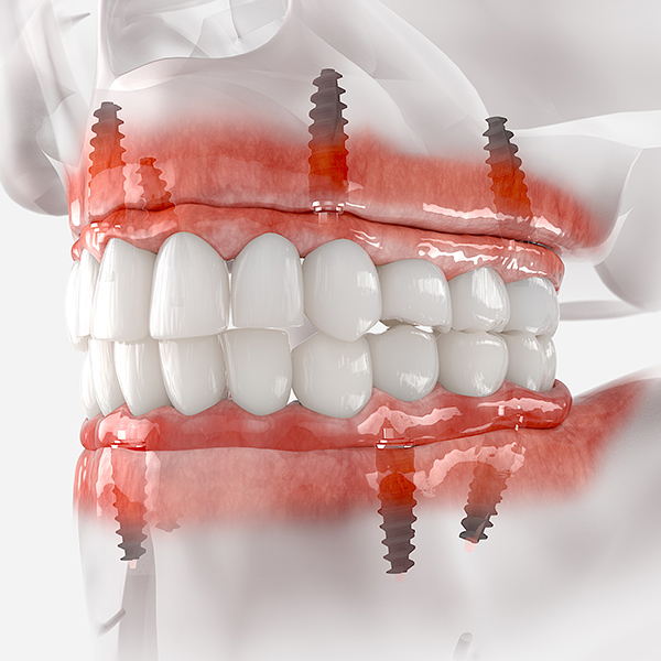 implant-supported denture