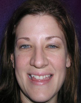 Huntington Beach full mouth reconstruction patient before treatment