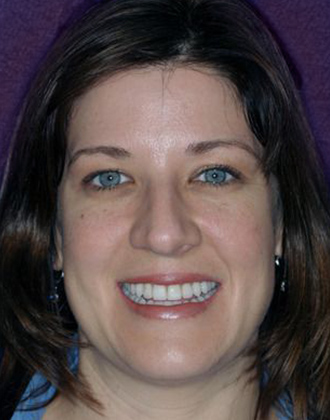 Huntington Beach full mouth reconstruction patient after treatment